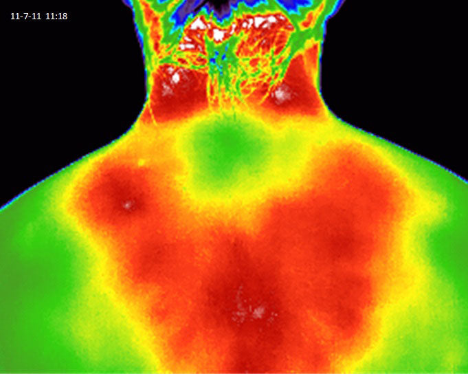 Heat image of a person's back using Elixir Mind Body Botanicals Relief Balm